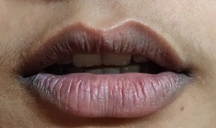 1Nguyên nhân môi dễ bị thâm, xỉn màu