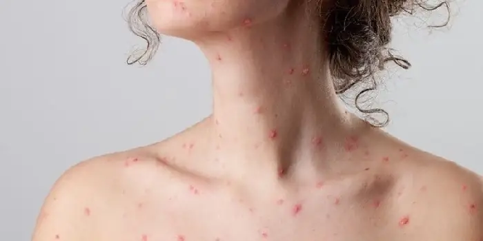 Bệnh thủy đậu là gì?