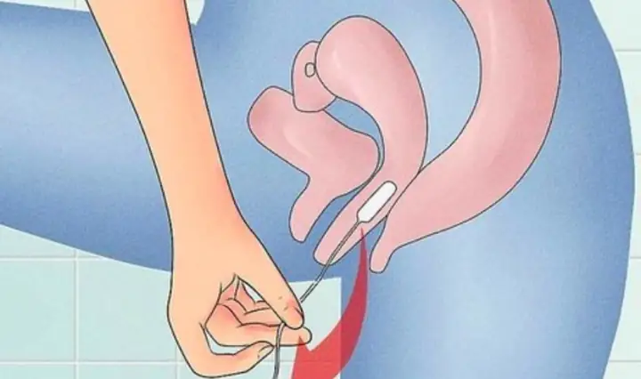 3.2 Cách thay băng vệ sinh dạng nén (Tampon)