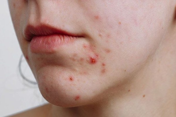 Rau má là cách trị mụn thâm cho bà bầu an toàn từ thiên nhiên