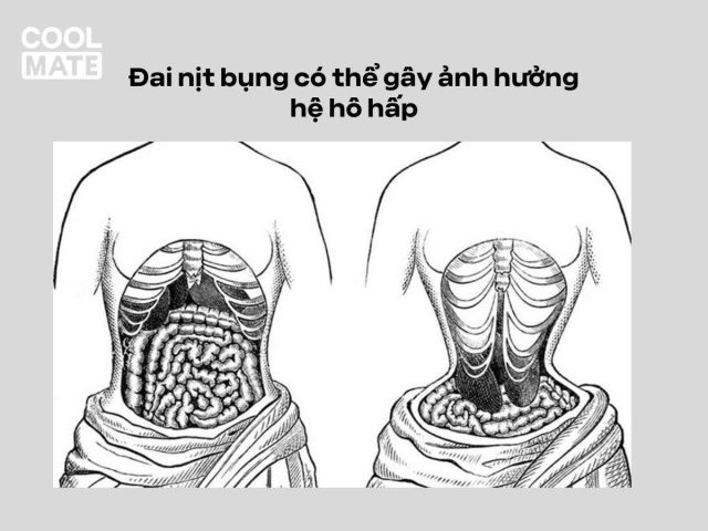 Có Nên Đeo Nịt Bụng Khi Tập Gym: Phân Tích Chuyên Sâu Từ Góc Nhìn Sức Khỏe Có Nên Đeo Nịt Bụng Khi Tập Gym: Phân Tích Chuyên Sâu Từ Góc Nhìn Sức Khỏe