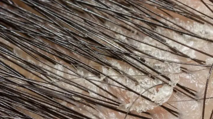 1Các nguyên nhân khiến tóc bị gàu