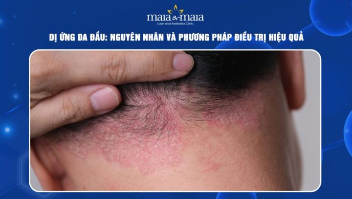 Cách trị dị ứng da đầu hiệu quả, an toàn và toàn diện