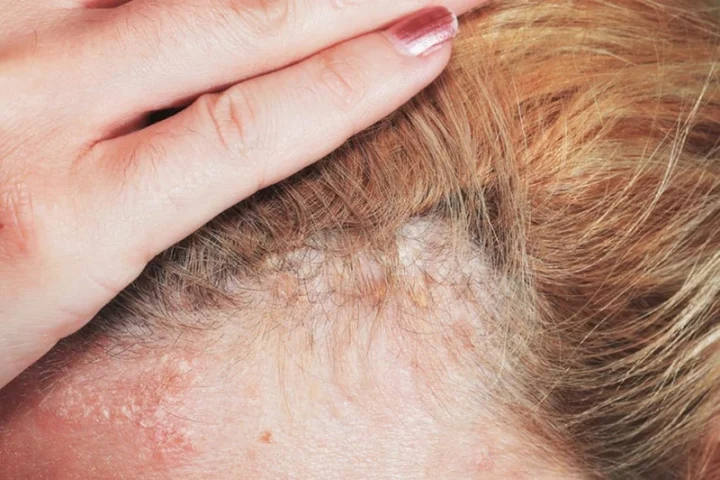Cách trị dị ứng da đầu hiệu quả, an toàn và toàn diện