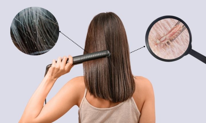 Ép tóc có hết chấy không: Phân tích chuyên sâu và giải pháp hiệu quả