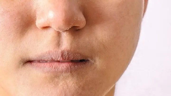 1Nguyên nhân da mặt bị khô vào mùa đông