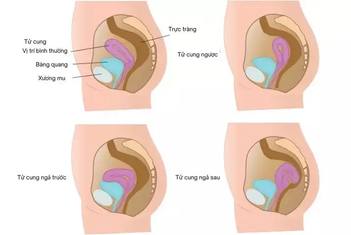 Vị trí của tử cung