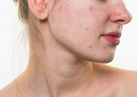 Phụ nữ đắp mặt nạ cấp nước cho da mụn