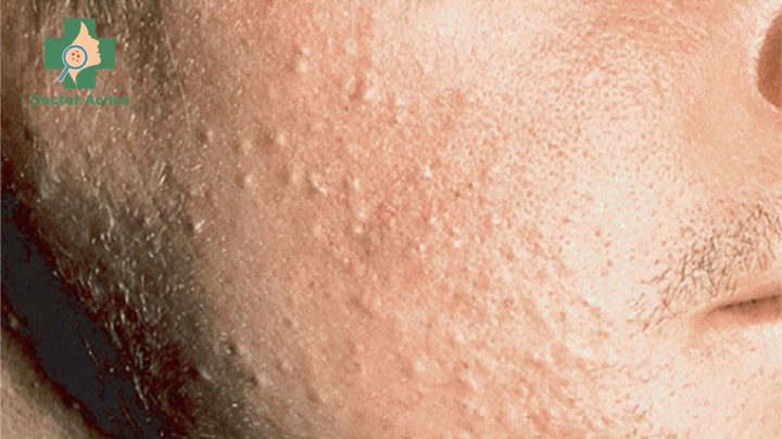 Mụn ẩn có tự hết không? Chuyên gia giải đáp và hướng dẫn điều trị