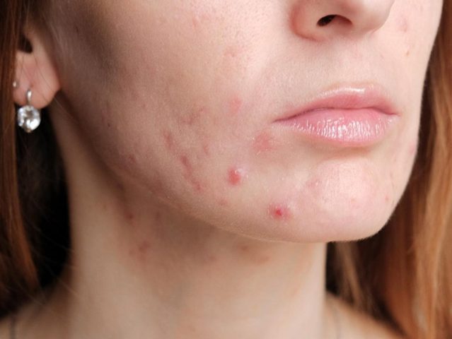 Mang Thai Có Mọc Mụn Không: Giải Đáp & Giải Pháp Toàn Diện