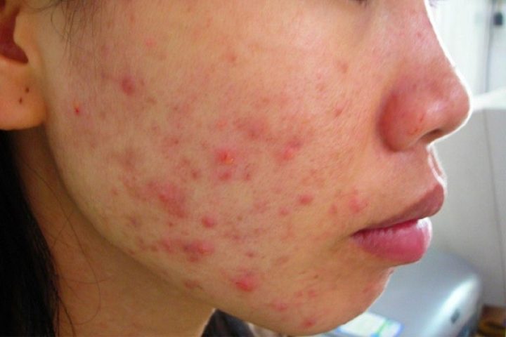 Mang Thai Có Mọc Mụn Không: Giải Đáp & Giải Pháp Toàn Diện