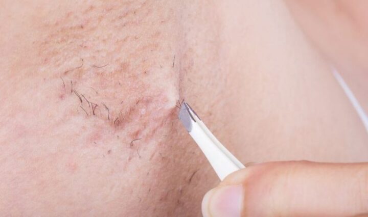 Nhổ, cạo lông nách thường xuyên khiến lỗ chân lông vùng da này to và da bị sẫm màu