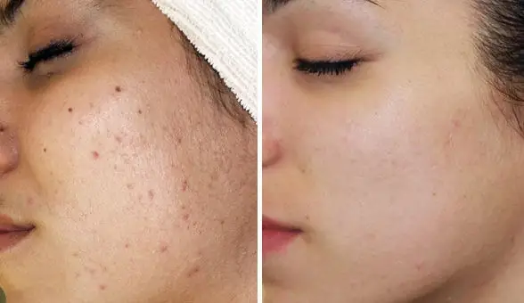 1. Quy trình thực hiện trị mụn bằng ánh sáng sinh học