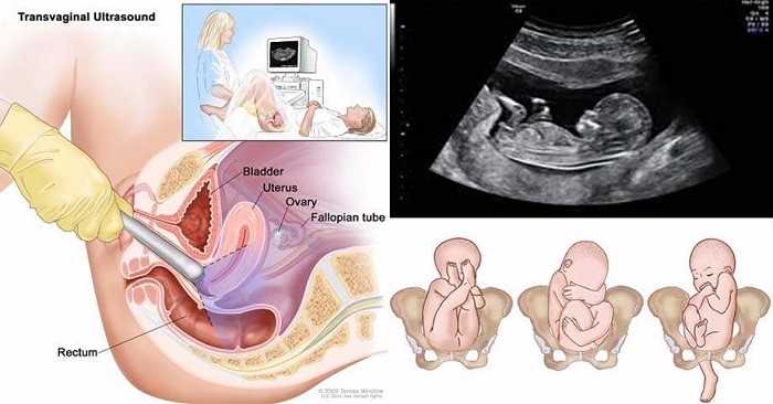 Siêu Âm Đầu Dò Có Ảnh Hưởng Đến Thai Không: Kiến Thức Toàn Diện