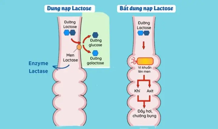 1Tìm hiểu về chứng bất dung nạp lactose