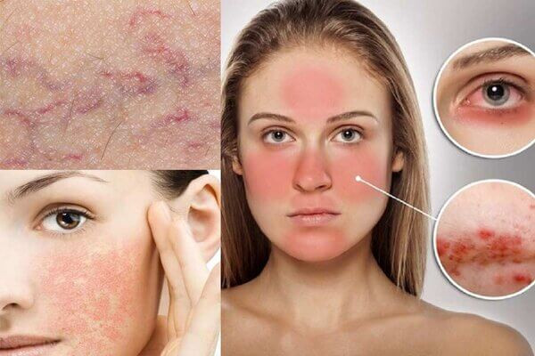 Thế nào là da nhạy cảm?
