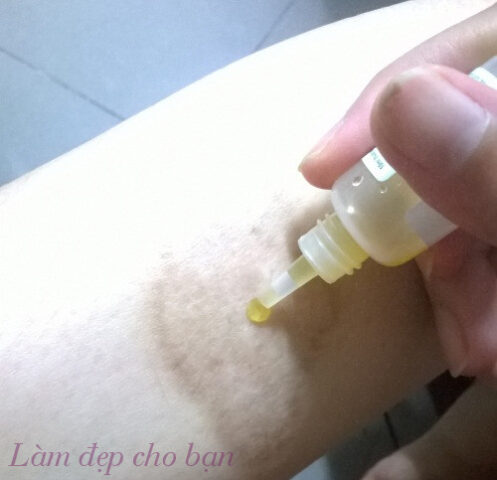Thoa nghệ tươi ngâm mật ong lên vết sẹo