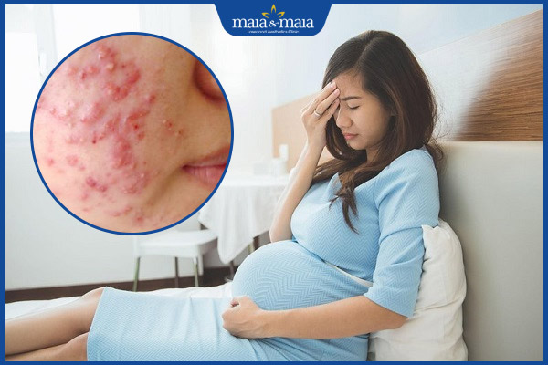 Mang Thai Có Mọc Mụn Không: Giải Đáp & Giải Pháp Toàn Diện