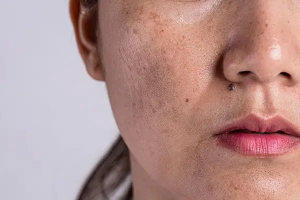 1. Vùng da mặt bị sạm nám