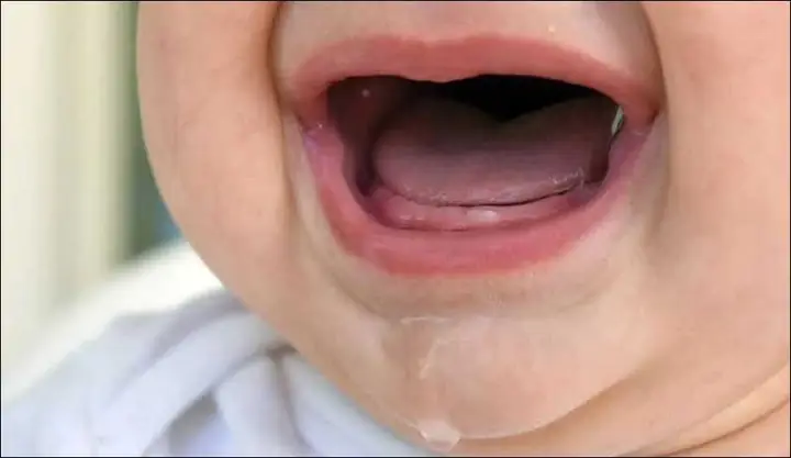 3Những dấu hiệu trẻ bị sốt và tiêu chảy khi mọc răng