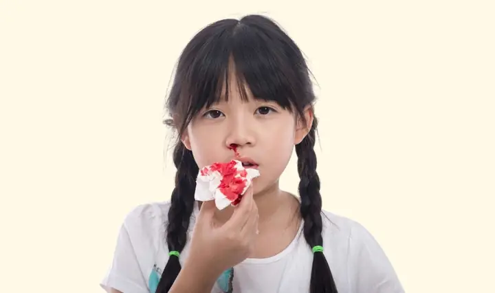 1Tìm hiểu về tình trạng chảy máu cam ở trẻ nhỏ
