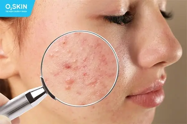 3. Hướng dẫn cách lựa chọn kem trị mụn hiệu quả và an toàn