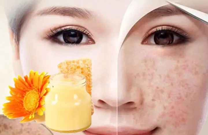 2.2 Trị nám, tàn nhang, sạm da