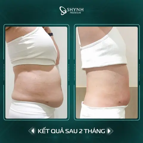 Công nghệ giảm cân cho mẹ bỉm sữa sau sinh mổ tại Shynh Premium
