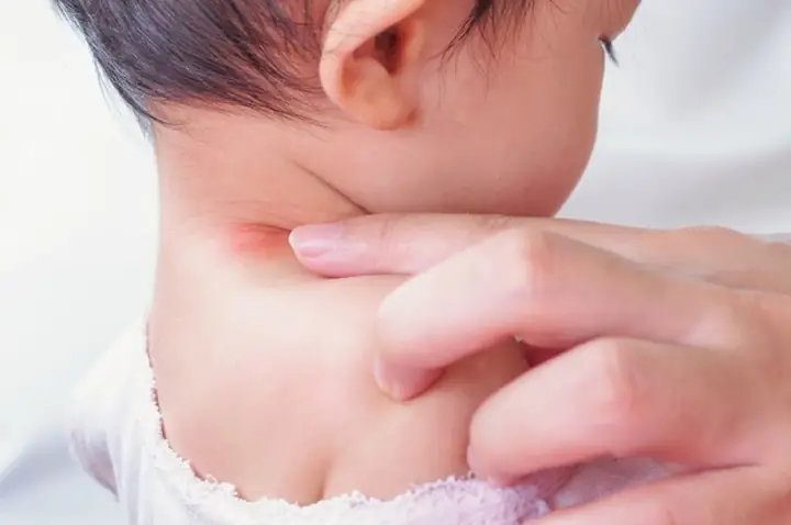 Cách trị hâm cổ cho bé hiệu quả và an toàn?