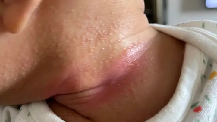 Cách trị hâm cổ cho bé hiệu quả và an toàn?