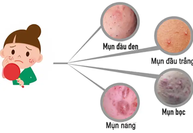 Nguyên nhân gây ra mụn ở tuổi dậy thì