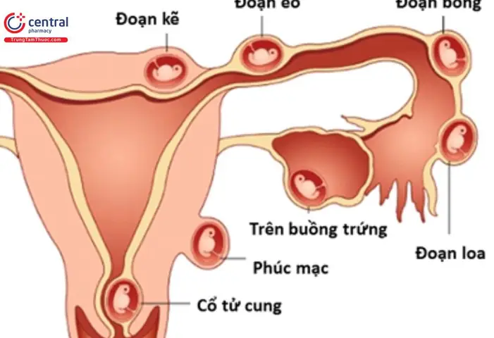 Mang thai ngoài tử cung rất nguy hiểm