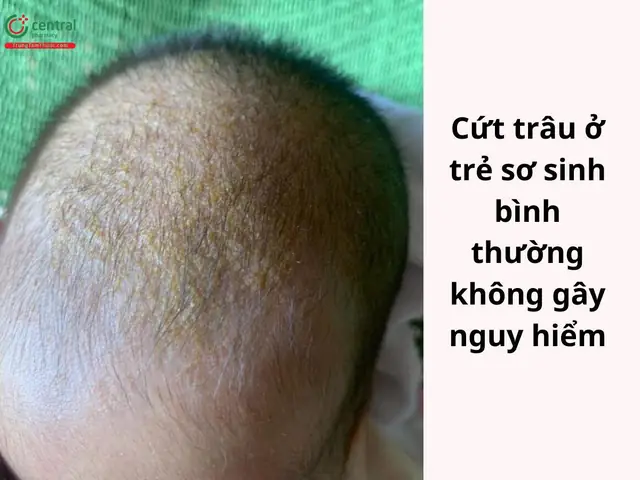 4Trẻ sơ sinh bị cứt trâu có nguy hiểm không?