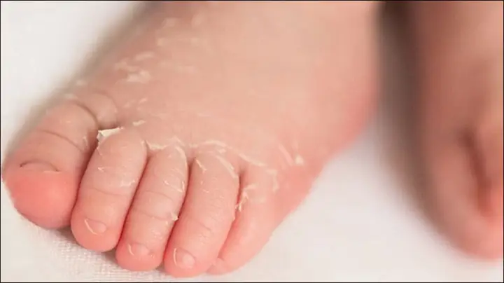 1Nguyên nhân trẻ sơ sinh bị khô da 1Nguyên nhân trẻ sơ sinh bị khô da