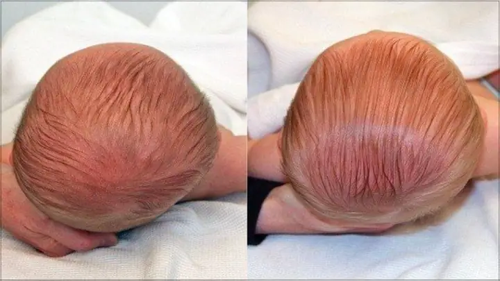 Đầu của bé bị ngắn và rộng