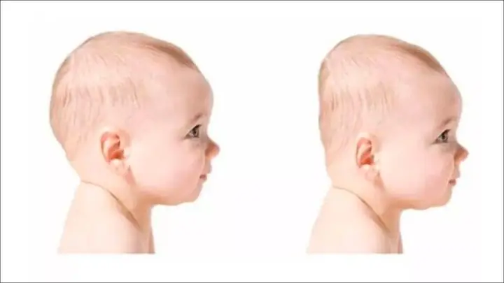 Phần sau đầu của bé phẳng hơn ở một bên