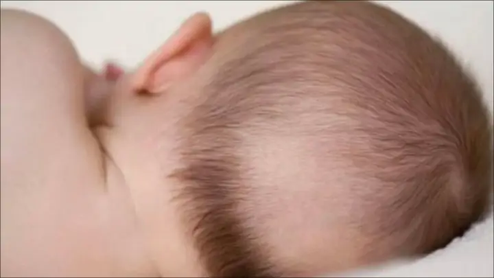 Tóc mọc ít ở phần đầu bị méo
