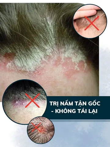 dầu gội đặc trị gàu mảng