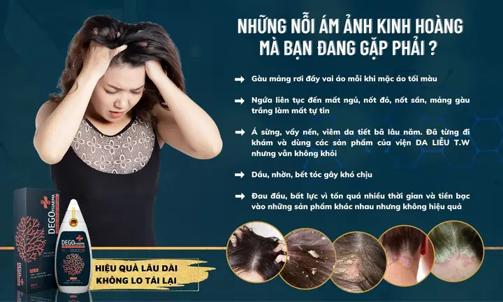 dầu gội đặc trị gàu mảng