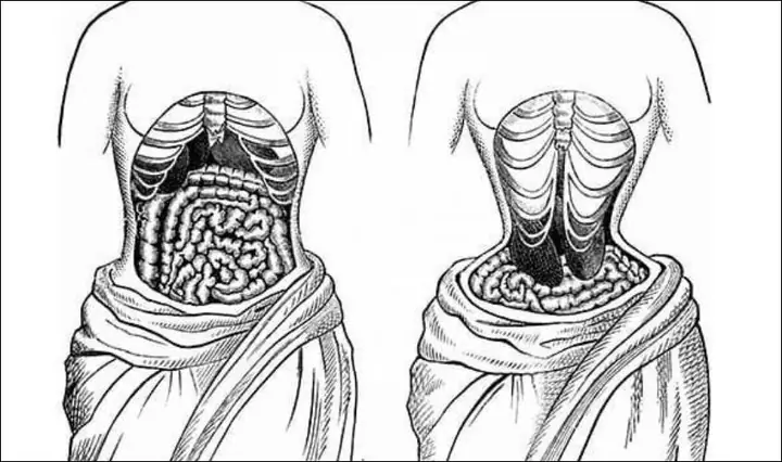 2.3 Gây ảnh hưởng cấu trúc xương sườn