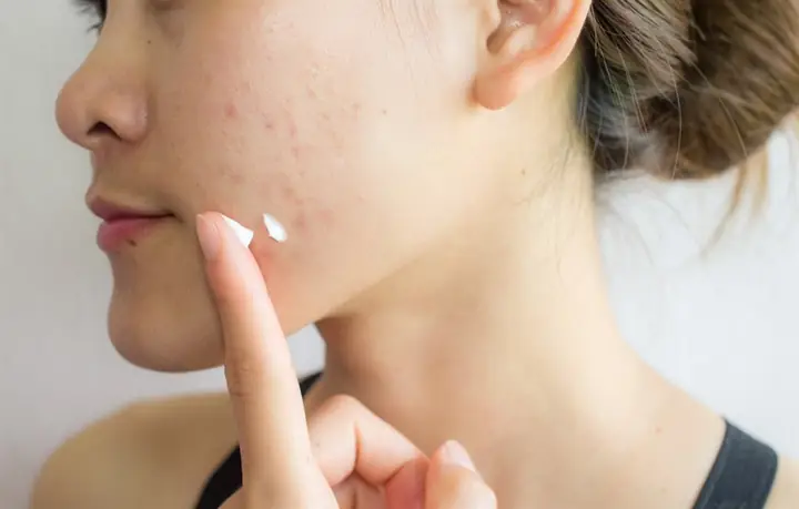 2Kem đánh răng có trị mụn được không?