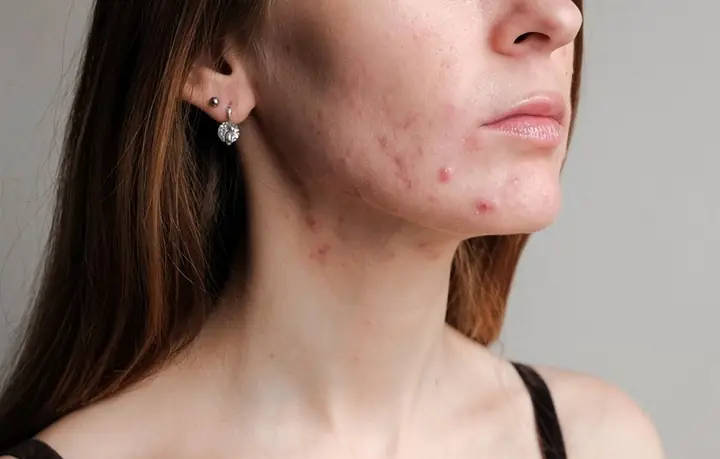 3Một số tác hại khi sử dụng kem đánh răng điều trị mụn