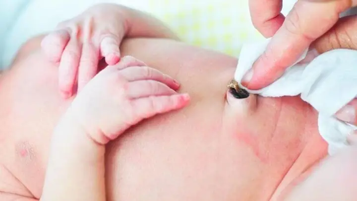 Hình ảnh rụng rốn ở trẻ sơ sinh bình thường