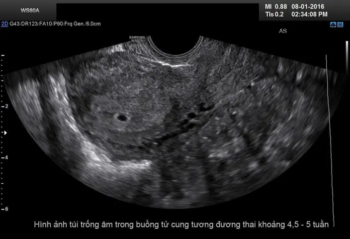 Siêu âm chẩn đoán thai sớm