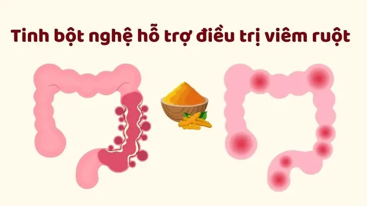 3Hỗ trợ điều trị viêm ruột