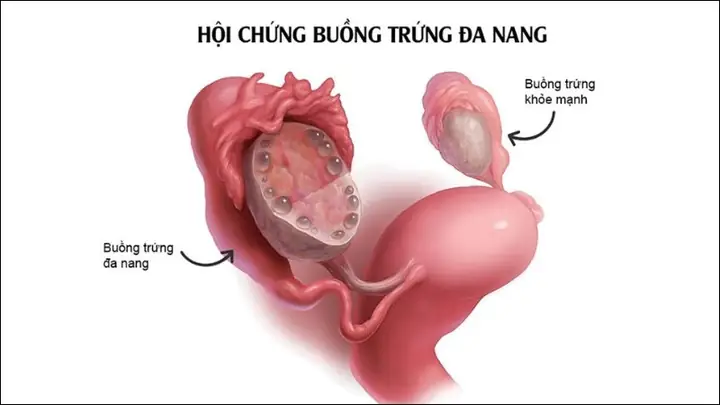 Kiểm soát hội chứng buồng trứng đa nang (PCOS)