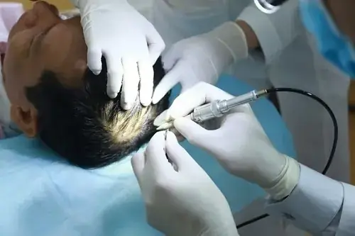 I. Cấy tóc sinh học là gì?