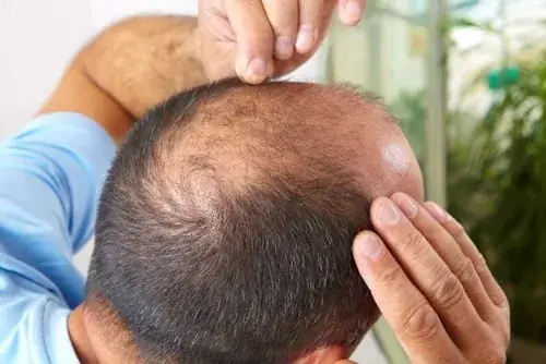 II. Cấy tóc sinh học giữ được bao lâu?