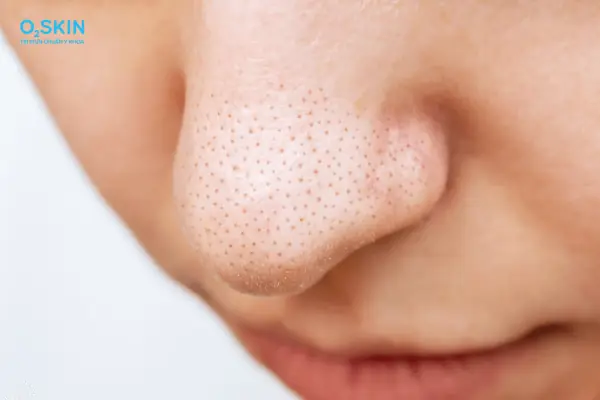 1. Vì sao nhiều người cho rằng kem đánh răng có thể trị mụn đầu đen?
