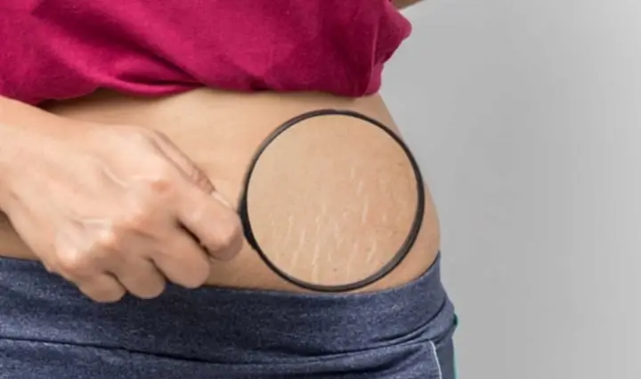 1Rạn da tuổi dậy thì là gì?